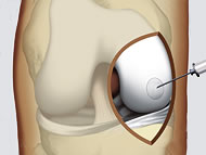 Zelltransplantation